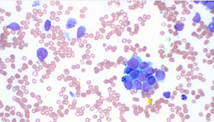 Photo of a slide of blood cells with many small red blood cells and a group of larger purple cells on the right