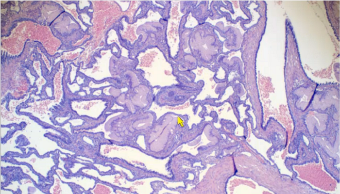 Photo of a slide of lung tissue (purple) under the microscope with large white spaces in the tissue