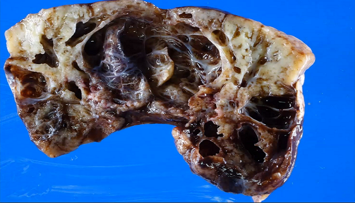Photo of a cross-section of the lung with large spaces in the tissue